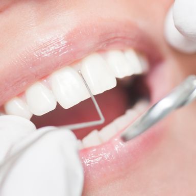 Prophylaxebehandlung an den Zähnen in Garbsen 
