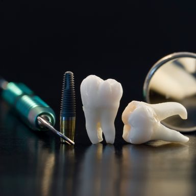 Zähne für Implantat-Beratung in Garbsen 